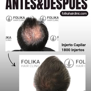 🛑 ¿Evitas las fotos de espaldas porque la coronilla empieza a clarear? 

La pérdida de pelo en el v