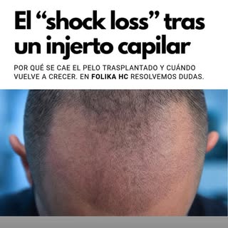 ¡Alerta pánico! 🚨 Te has sometido a un injerto capilar, las costras han caído, te ves genial y de r