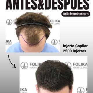 ¿Sientes que la alopecia en las entradas y la zona frontal avanza sin control y desdibuja tus faccio