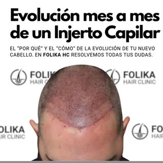 ¿Operarme hoy y lucir tupé la semana que viene? Ojalá fuera magia, pero es ciencia y medicina. 🧬⏳ S