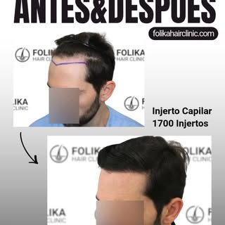 ¿Llevas tiempo intentando peinarte diferente para disimular esas entradas que cada vez son más profu