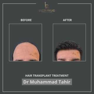Restoring confidence with a natural, refined result.

Hair transplant treatment by Dr. Muhammad Tahi