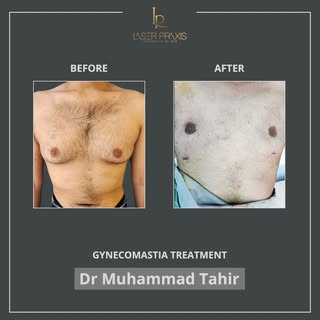 A successful gynecomastia result isn't measured by what's removed - it's measured by what remains: n