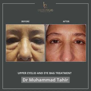 Upper eyelid heaviness. Under-eye bags. A tired appearance that doesn’t reflect how you feel.

Upper