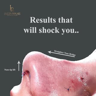 Rhinoplasty is a procedure that demands experience.

With over 25 years in cosmetic surgery, Dr Muha