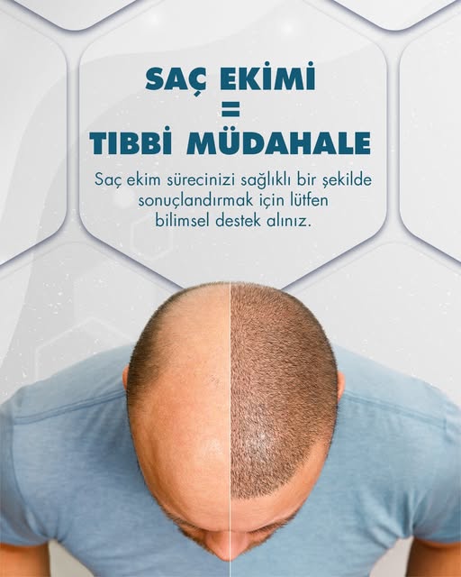 Saç ekimi, tıbbi bir operasyondur. Bu süreci sağlıklı bir şekilde sonuçlandırmak için uzmanların yak