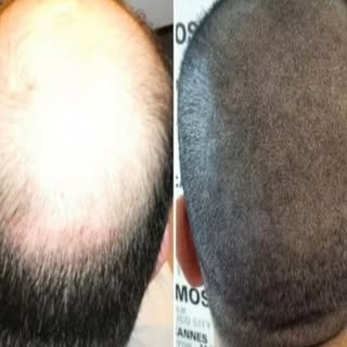 Saç simülasyonu ile kafadaki açık bölgeler pigment atışları ile doldurulur ve dip gölgelendirme ile 