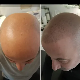 Saç simülasyonu ile kafadaki açık bölgeler pigment atışları ile kıl kökü görünümü verilerek doldurul