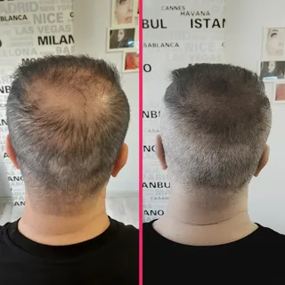 Saç simülasyonu ile kafadaki açık bölgeler pigment atışları ile kıl kökü görünümü verilerek doldurul