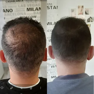 Saç simülasyonu ile kafadaki açık bölgeler pigment atışları ile kıl kökü görünümü verilerek doldurul