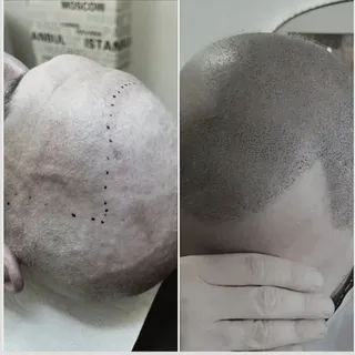 Saç simülasyonu ile kafadaki açık bölgeler pigment atışları ile kıl kökü görünümü verilerek doldurul