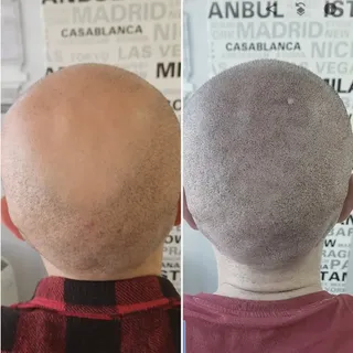 Saç simülasyonu ile kafadaki açık bölgeler pigment atışları ile kıl kökü görünümü verilerek doldurul