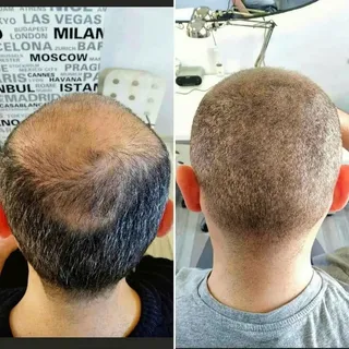 Saç simülasyonu ile kafadaki açık bölgeler pigment atışları ile kıl kökü görünümü verilerek doldurul