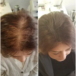 Saç simülasyonu ile kafadaki açık bölgeler pigment atışları ile kıl kökü görünümü verilerek doldurul
