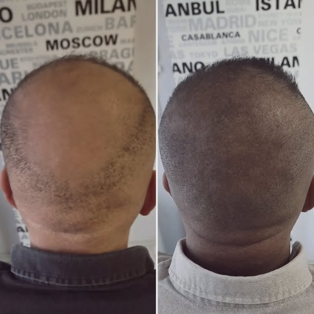 Saç simülasyonu ile kafadaki açık bölgeler pigment atışları ile kıl kökü görünümü verilerek doldurul