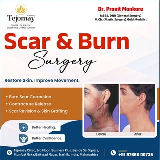 🔥 Scar & Burn Surgery – Restore Skin. Improve Movement.

Burn scars can affect not only appearance 