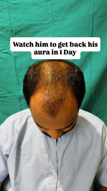 तुझं टक्कल तुमच्या आत्मविश्वासाच्या मध्ये येतंय? 🤦‍♂️
लग्नाची स्थळं नाकारली जाणं असो किंवा फोटोमध्य