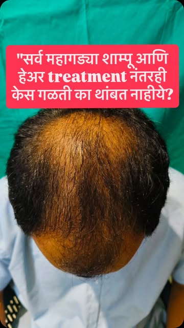 तुझं टक्कल तुमच्या आत्मविश्वासाच्या मध्ये येतंय? 🤦‍♂️
लग्नाची स्थळं नाकारली जाणं असो किंवा फोटोमध्य