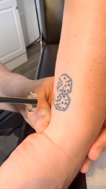 First Laser Tattoo a removal session in progress #alternativelaserhealth #lasertattooremoval #tattoo
