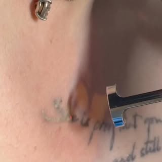 Tattoo removal session in progress! Please call or Dm us to book your appointment 📞 (905) 451 4545
