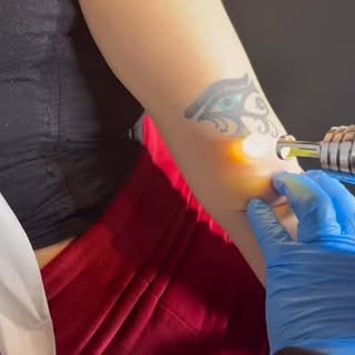 Tattoo removal session in progress #tattooremoval #lasertattooremoval