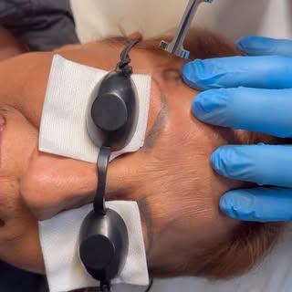 Eyebrow laser tattoo removal session #alternativelaserhealth #eyebrowlaserremoval