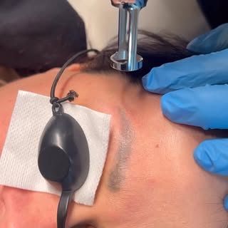 Eyebrow laser removal #laserremoval #eyebrowremoval