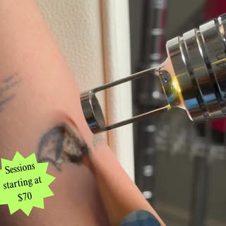 Tattoo removal session in progress #tattooremoval #lasertattooremoval