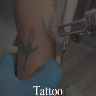 Tattoo removal in progress #alternativelaserhealth #tattooremoval #lasertattooremoval