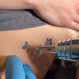 Tattoo removal session in progress #tattooremoval #lasertattooremoval