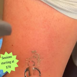 Tattoo@removal session in progress #alternativelaserhealth #lasertattooremoval