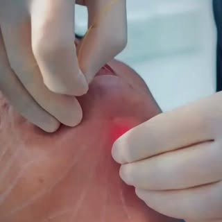 “Endolazer ile çene hattında tek seansta gözle görülür sıkılaşma ve kontur belirginliği. Görüntüde s