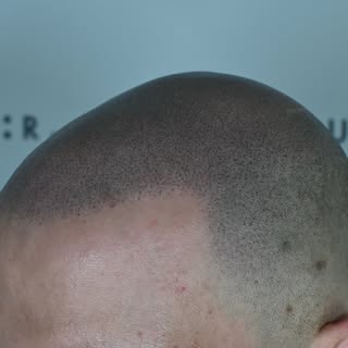 • Vælg rigtigt • Vælg kvalitet • Vælg illuhair •

Hvis man er frustreret over sit hårtab bliver live