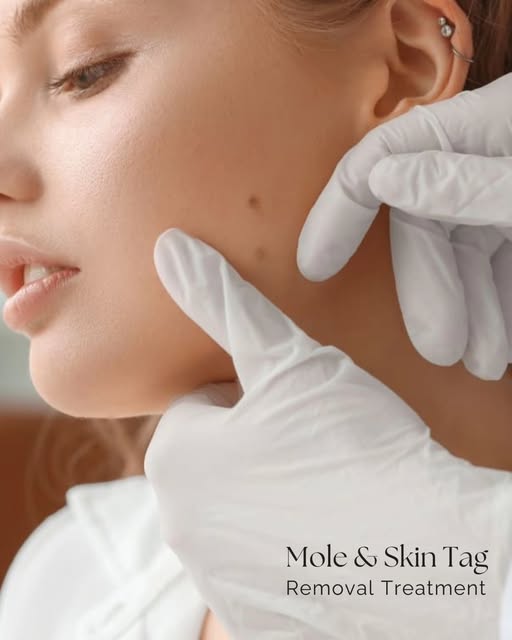 Mole & Skin Tag Removal ✨

Concerned about a mole or skin tag? Get it professionally assessed before