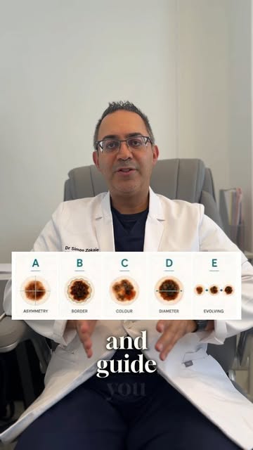Know Your Moles: The ABCDE Rule 🔎

Not every mole is a cause for concern, but changes in a mole sho