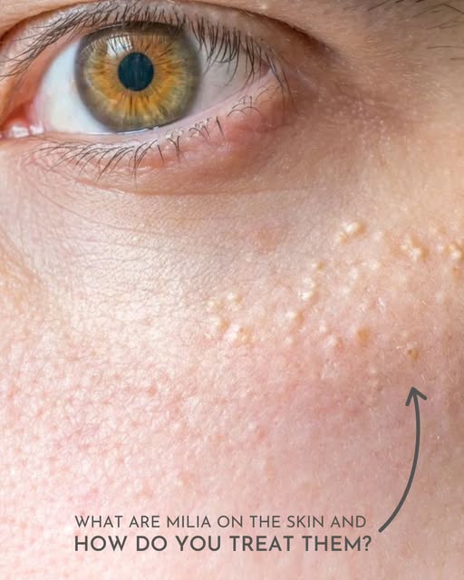 ✨ Milia Removal Treatment

Small white bumps. Clearer-looking skin.

Milia are tiny, keratin-filled 