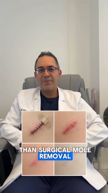 MOLE REMOVAL, WITH DERMATOLOGY AT THE CORE

A mole you’re concerned about deserves more than a cosme