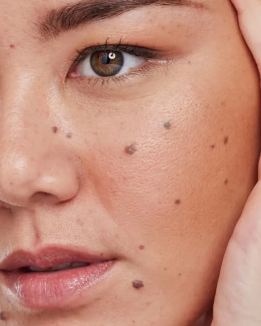 TYPES OF MOLES & HOW WE TREAT THEM

Moles are common skin growths, and most are harmless. However, n