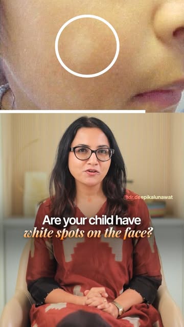 Does Every White Spot Mean Vitiligo?

#ChildSkinCare #KidsSkinCare #ParentingTips #SkinCareTips #Whi