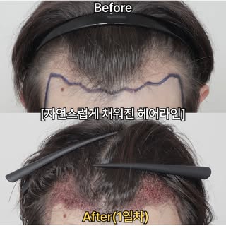 왜 어떤 모발이식은 티가 나고, 어떤 모발이식은 티가 안 날까요? 🤔

그 차이는 헤어라인 디자인에 있습니다.

원래 사람의 헤어라인은 자를 대고 그은 듯한 일직선이 아닙니다.
