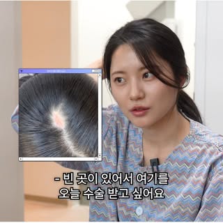 정수리 흉터성 탈모, 모발이식으로 커버할 수 있을까?🤔

흉터의 크기와 두피 상태에 따라 필요한 필요한 모수는 달라질 수 있습니다.

실제 상담을 통해 확인해 본 정수리 흉터 부