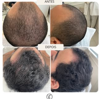 Este é, sem dúvida, um dos antes e depois mais marcantes que já acompanhamos na clínica.

Por trás d