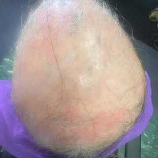 #hair restoration 
#scalp-treatments
#trichologyhair&scalpclinic
#tricho-clinic.net