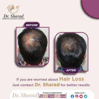 Before and After results of hair transplant!

For Consultation:
📍 https://www.drsharadkumar.com/
☎ 