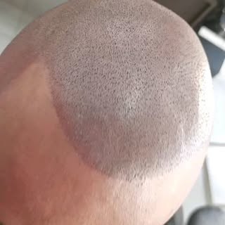 No filter 😉 . Hair loss solution. 
all hairlines are tailored and bespoke to each individual client