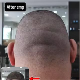 The result and details healed after 1 month
#alopecia #alopeciaareata #alopeciaawareness #scalpmicro