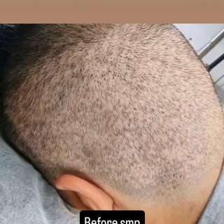 #ScalpMicropigmentation #SMP #SMPArtist #SMPLebanon #ScalpMicropigmentationLebanon