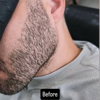 Beard Micropigmentation