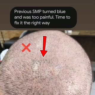Painful experience. Blue healed pigment. He stopped after his first SMP with another artist. Now we'