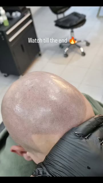 Alopecia — see the difference before and after SMP.”